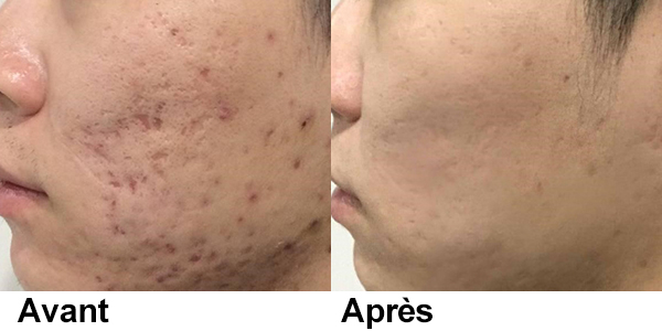 tattoo removal laser