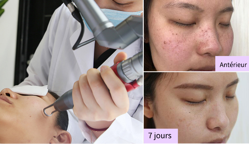 machine de détatouage au laser